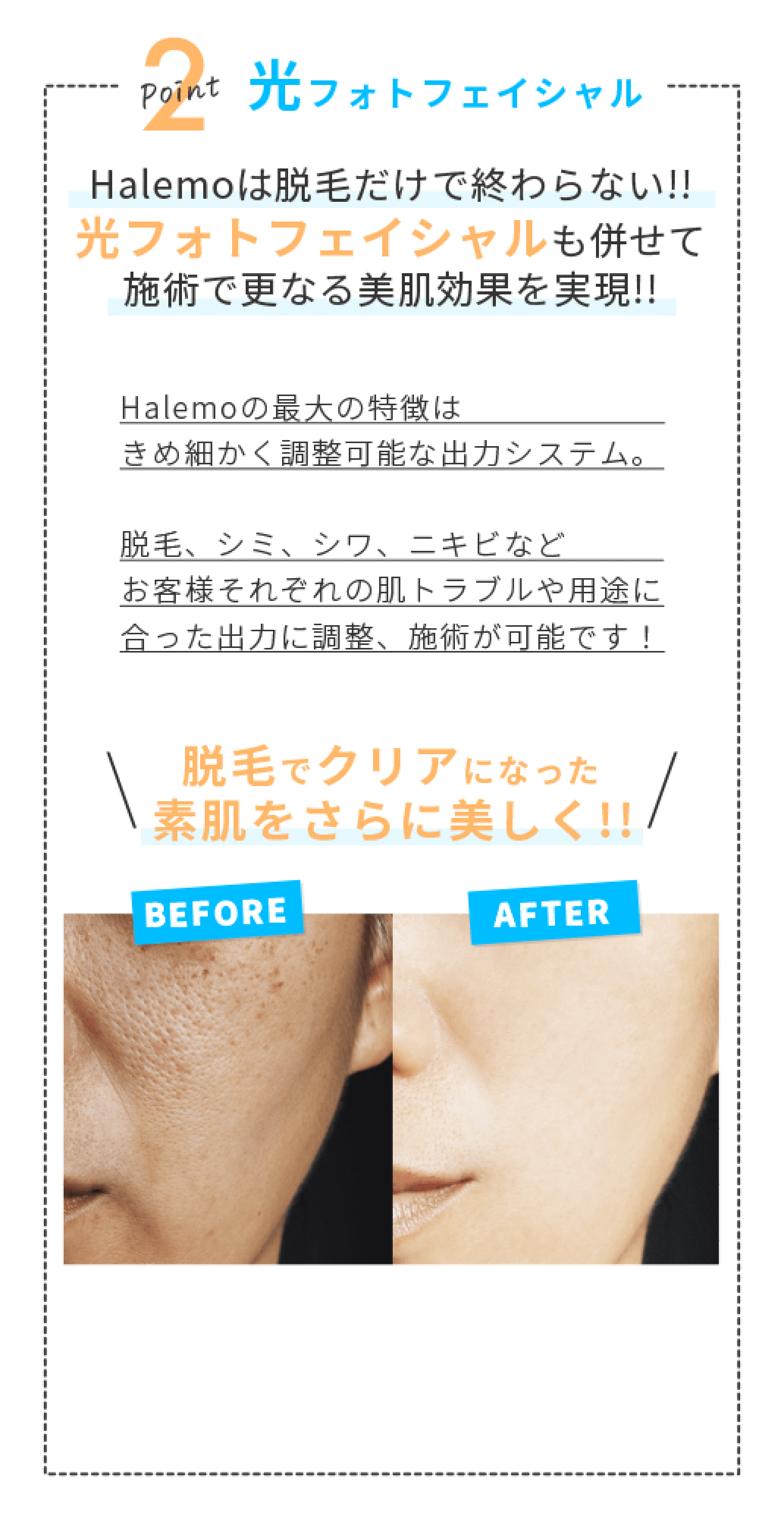 Point2 光フォトフェイシャル Halemoは脱毛だけで終わらない！！光フォトフェイシャルも併せて施術で更なる美肌効果を実現！！　Halemoの最大の特徴はきめ細かく調整可能な出力システム。脱毛、シミ、シワ、ニキビなどお客様それぞれｎ肌トラブルや用途に合った出力に調整、施術が可能です！ 脱毛でクリアになった素肌をさらに美しく！！